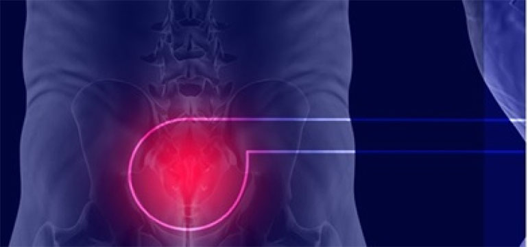 Cisto Pilonidal